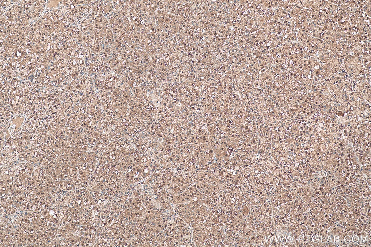 IHC staining of human liver cancer using 27449-1-AP