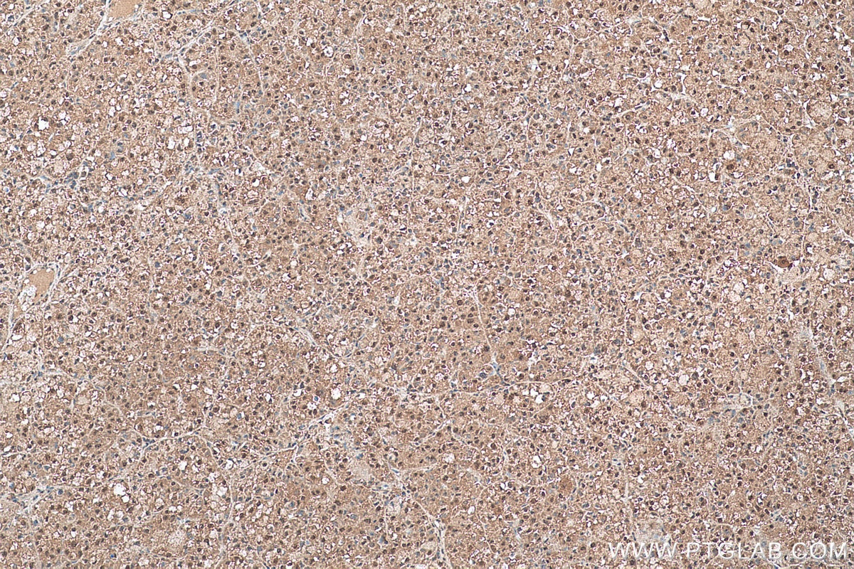 Immunohistochemistry (IHC) staining of human liver cancer tissue using SELENBP1 Polyclonal antibody (27449-1-AP)