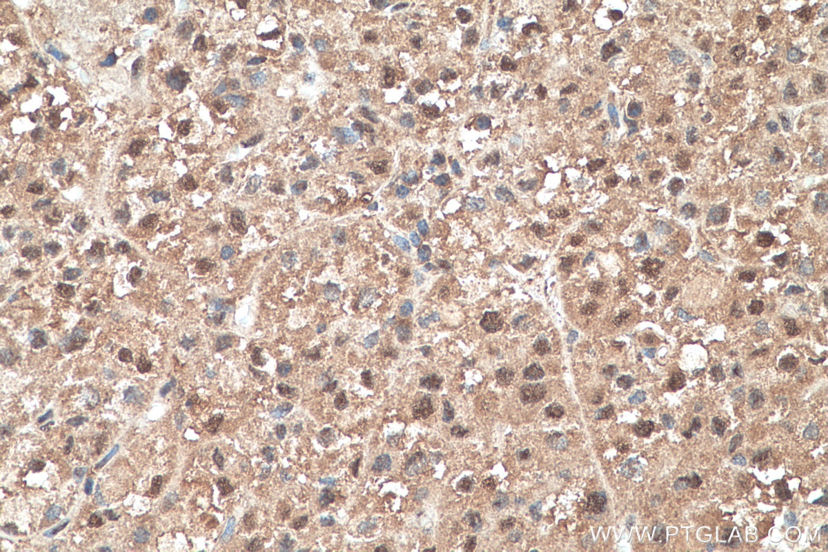 Immunohistochemistry (IHC) staining of human liver cancer tissue using SELENBP1 Polyclonal antibody (27449-1-AP)