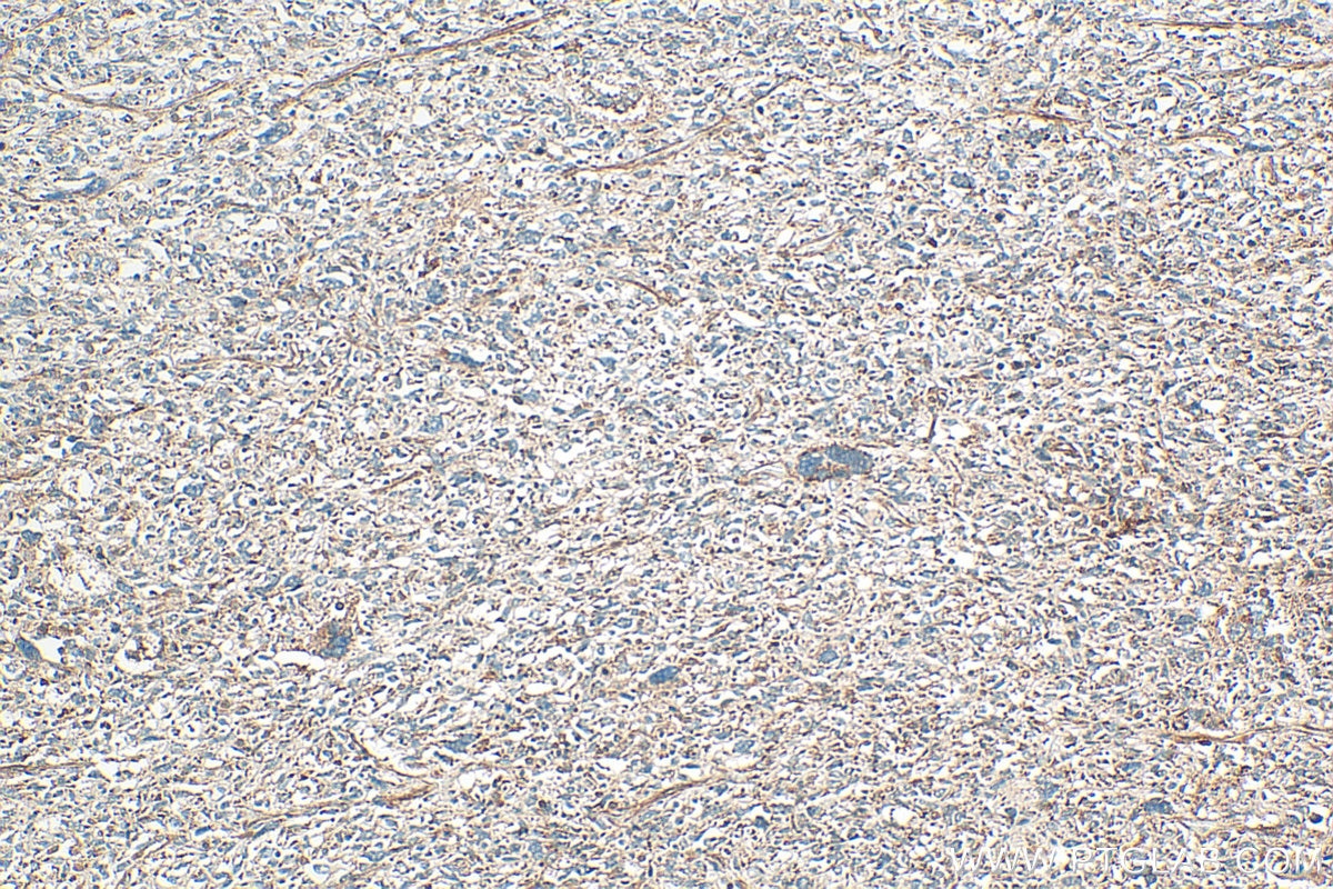 IHC staining of human pancreas cancer using 32860-1-AP (same clone as 32860-1-PBS) Immunohistochemistry (IHC) staining of human pancreas cancer tissue using SELENOO Polyclonal antibody (32860-1-AP)