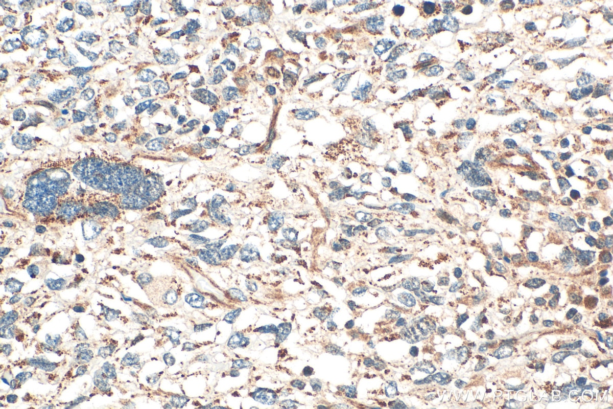 IHC staining of human pancreas cancer using 32860-1-AP (same clone as 32860-1-PBS) Immunohistochemistry (IHC) staining of human pancreas cancer tissue using SELENOO Polyclonal antibody (32860-1-AP)