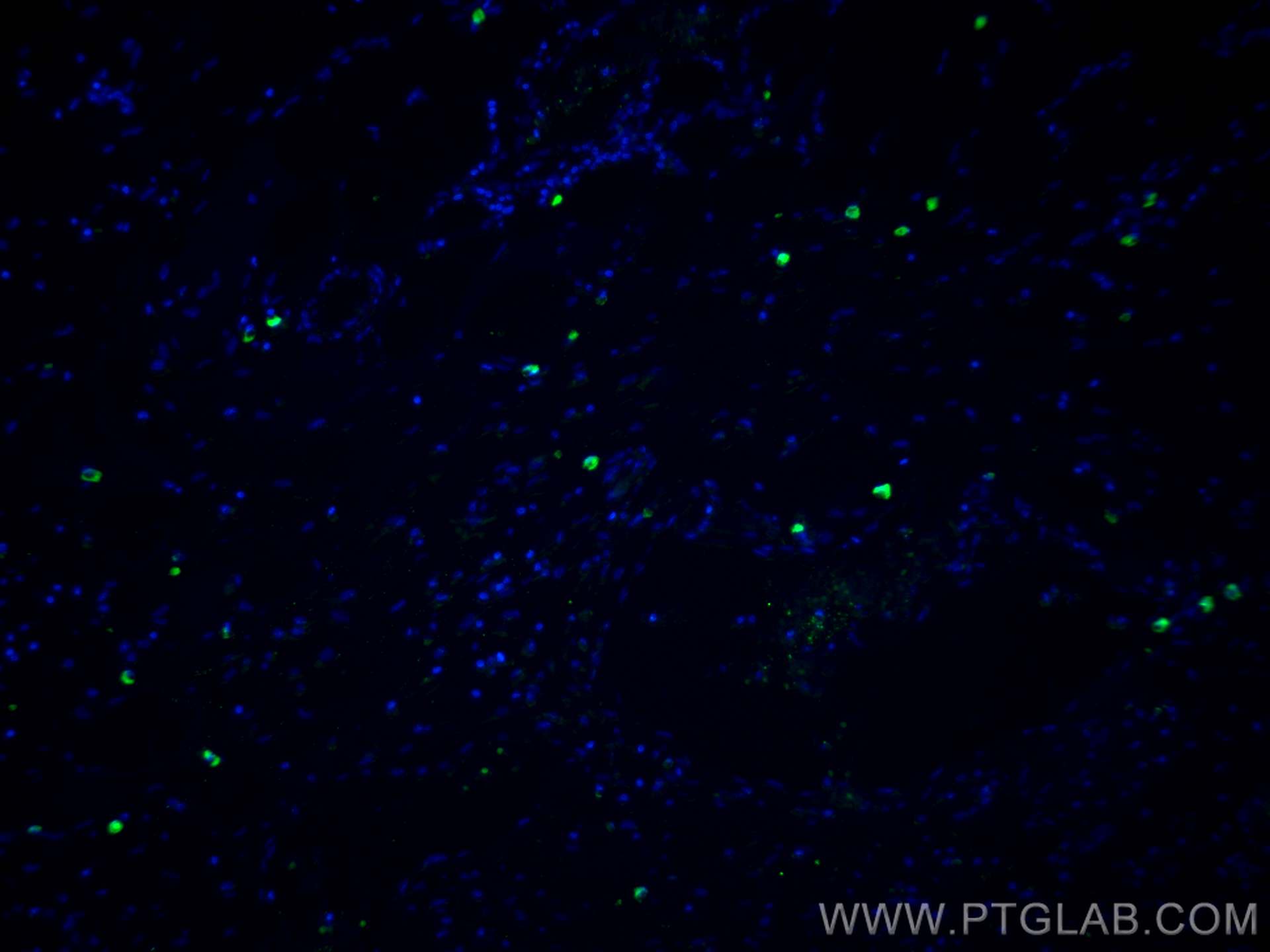 Immunofluorescence (IF) / fluorescent staining of human colon cancer tissue using L-selectin / CD62L Polyclonal antibody (26477-1-AP)