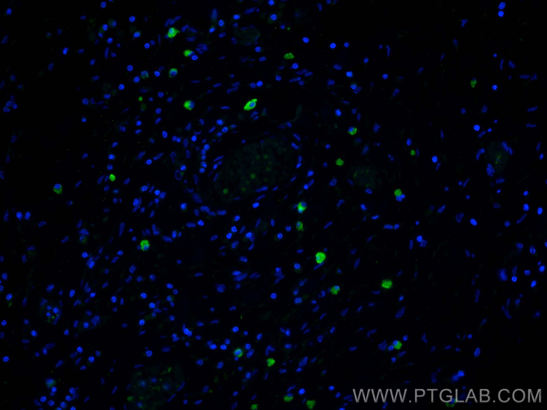 Immunofluorescence (IF) / fluorescent staining of human colon cancer tissue using CD62L Polyclonal antibody (26477-1-AP)