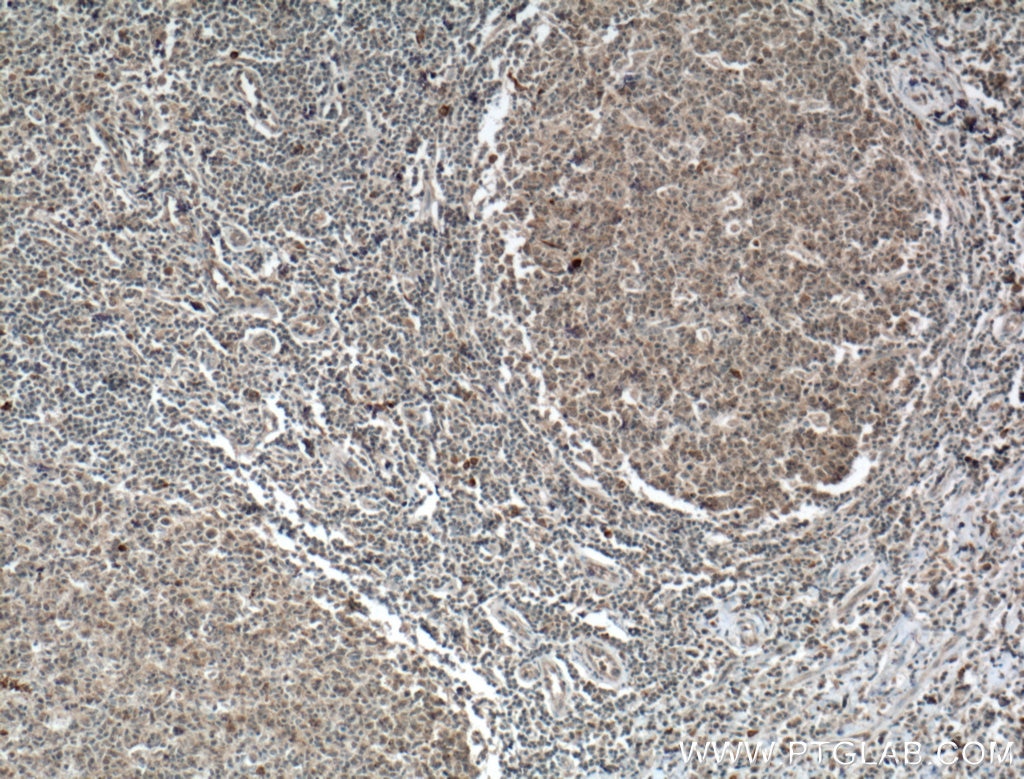 Immunohistochemistry (IHC) staining of human tonsillitis tissue using CD62L Polyclonal antibody (26477-1-AP)