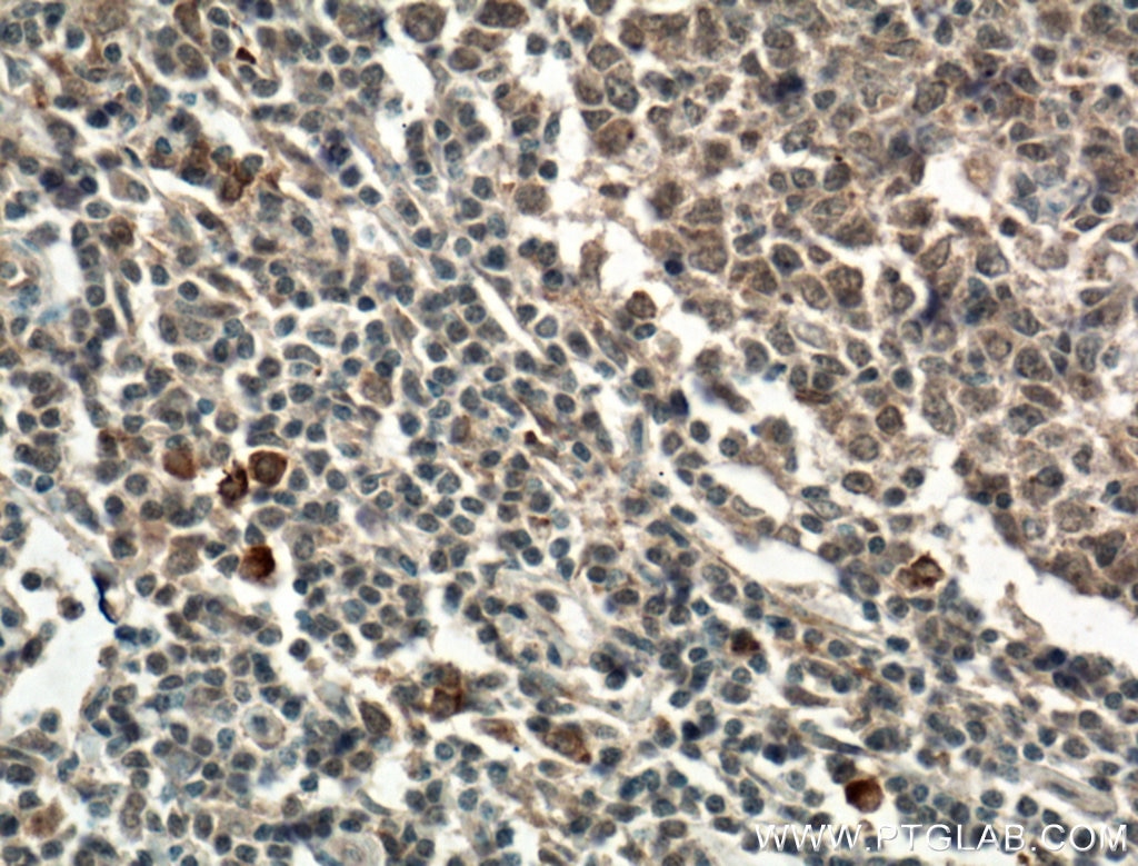 Immunohistochemistry (IHC) staining of human tonsillitis tissue using CD62L Polyclonal antibody (26477-1-AP)