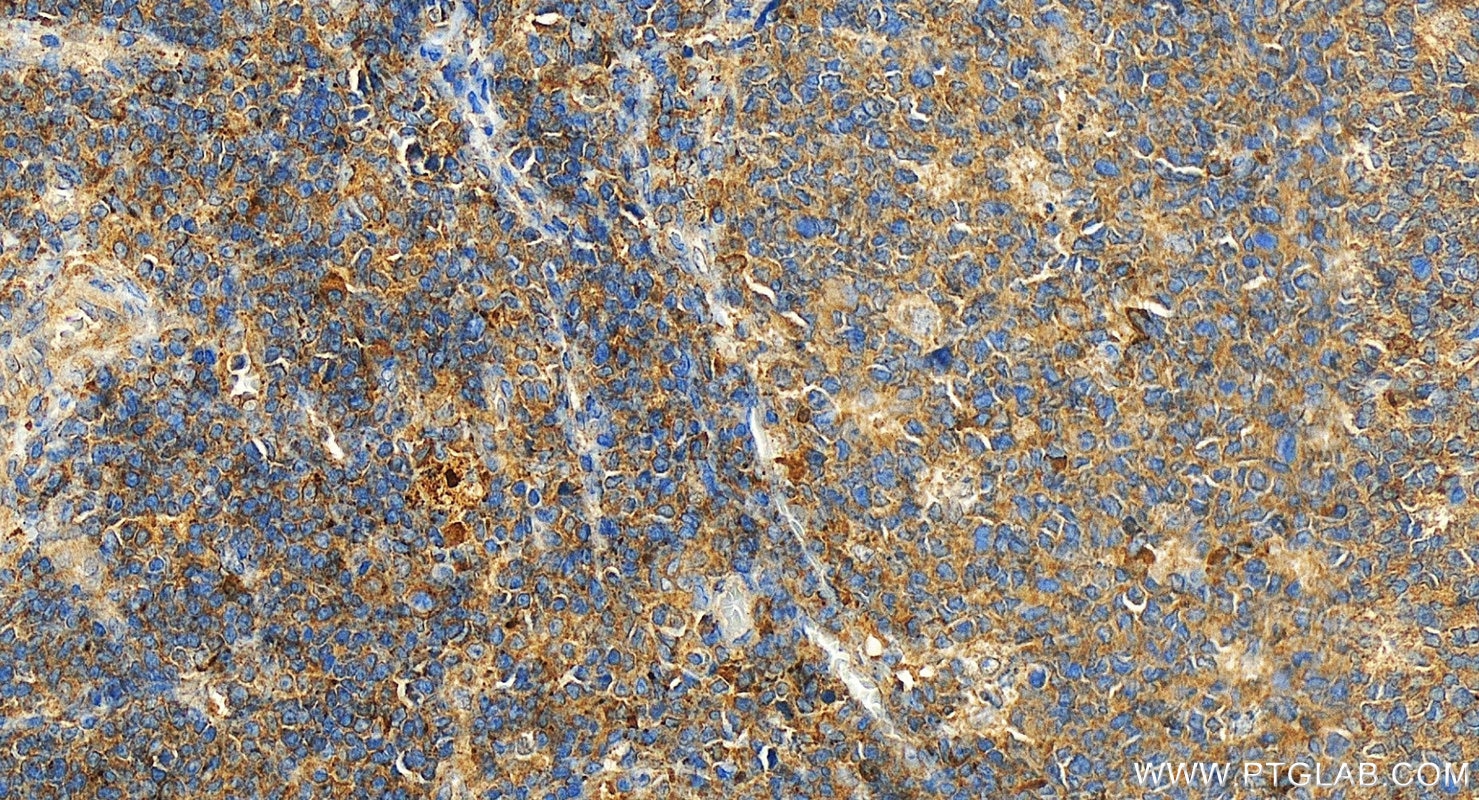 Immunohistochemistry (IHC) staining of human tonsillitis tissue using CD62L Polyclonal antibody (26477-1-AP)
