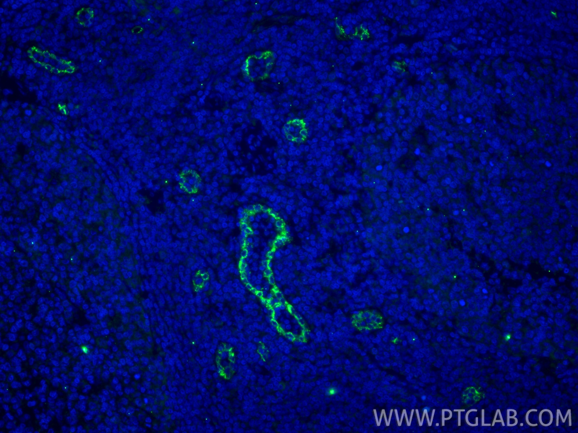Immunofluorescence (IF) / fluorescent staining of human tonsillitis tissue using P-selectin / CD62P Polyclonal antibody (13304-1-AP)
