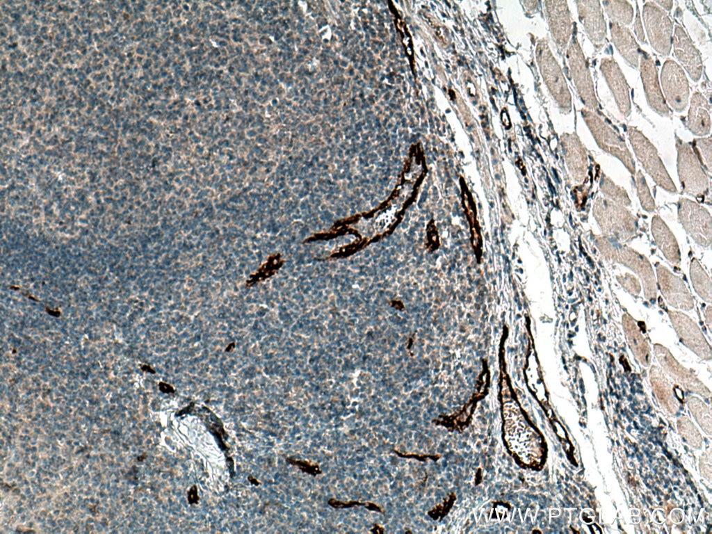 Immunohistochemistry (IHC) staining of human tonsillitis tissue using P-selectin / CD62P Polyclonal antibody (13304-1-AP)