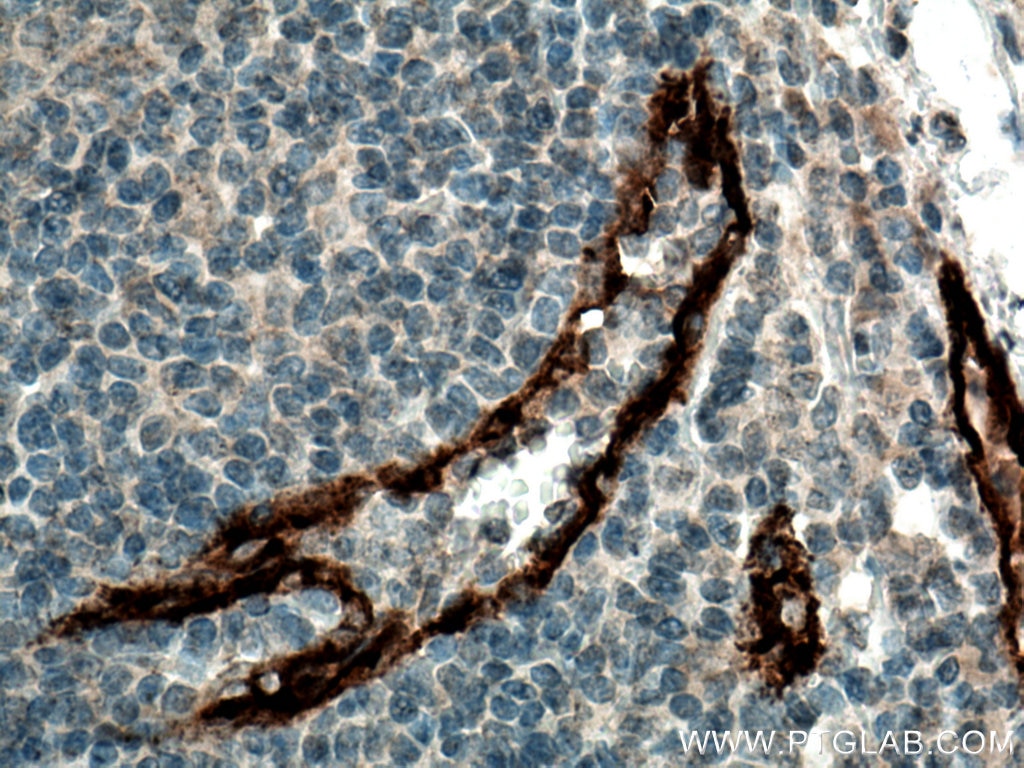 IHC staining of human tonsillitis using 13304-1-AP