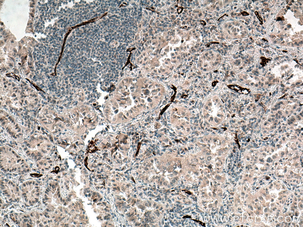 Immunohistochemistry (IHC) staining of human lung cancer tissue using P-selectin / CD62P Polyclonal antibody (13304-1-AP)