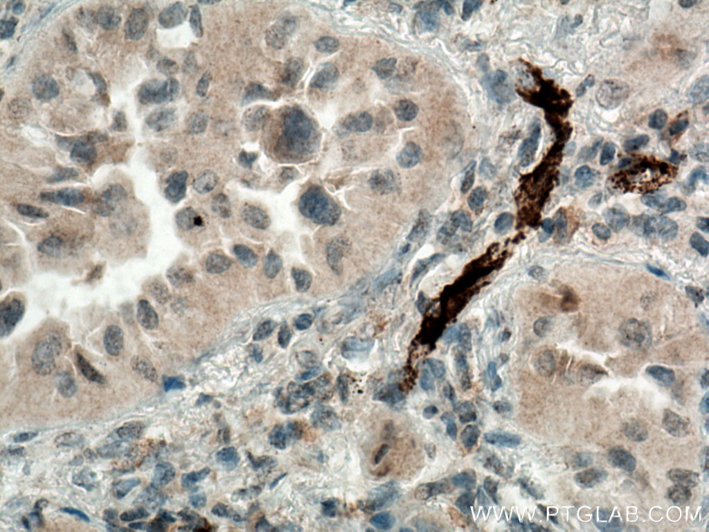 Immunohistochemistry (IHC) staining of human lung cancer tissue using P-selectin / CD62P Polyclonal antibody (13304-1-AP)