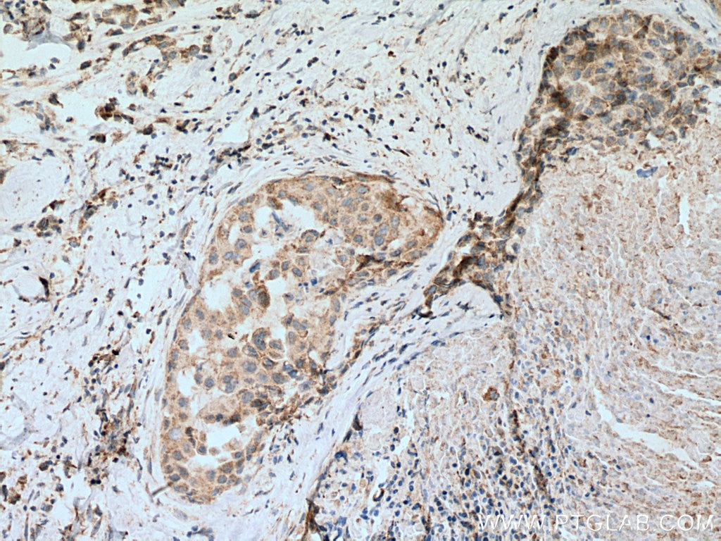 Immunohistochemistry (IHC) staining of human breast cancer tissue using SEMA4A Polyclonal antibody (27359-1-AP)