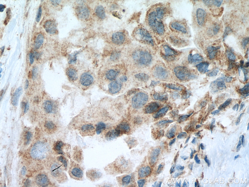 Immunohistochemistry (IHC) staining of human breast cancer tissue using SEMA4A Polyclonal antibody (27359-1-AP)