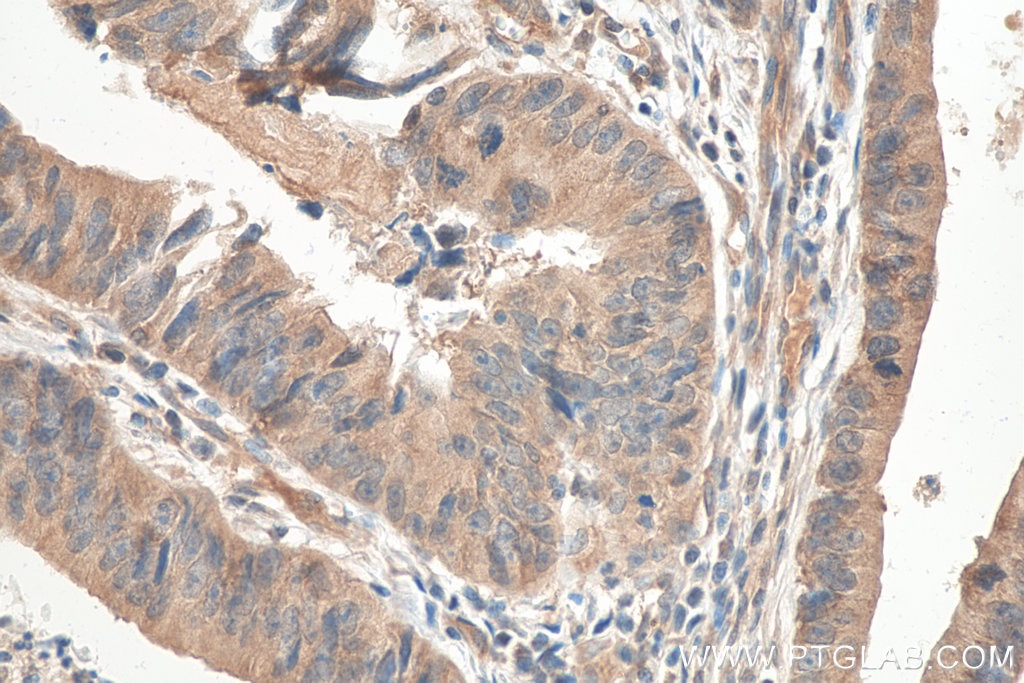 Immunohistochemistry (IHC) staining of human colon cancer tissue using SEMA4B Polyclonal antibody (29191-1-AP)