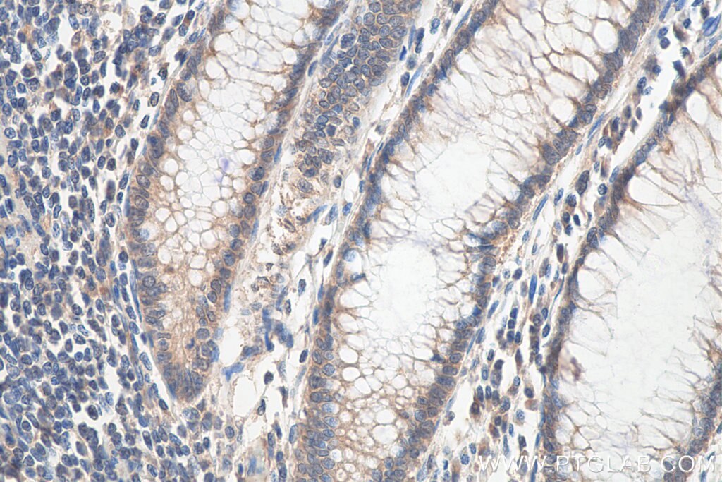 IHC staining of human colon cancer using 29191-1-AP