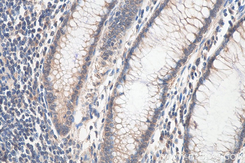 Immunohistochemistry (IHC) staining of human colon cancer tissue using SEMA4B Polyclonal antibody (29191-1-AP)