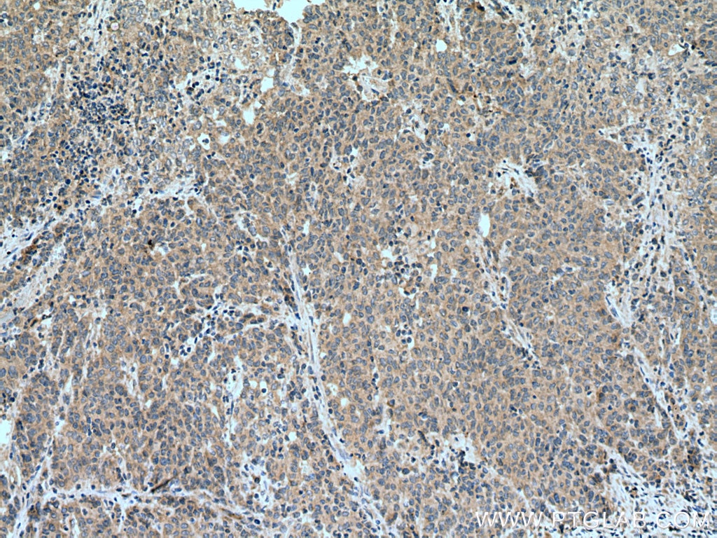 IHC staining of human stomach cancer using 28402-1-AP