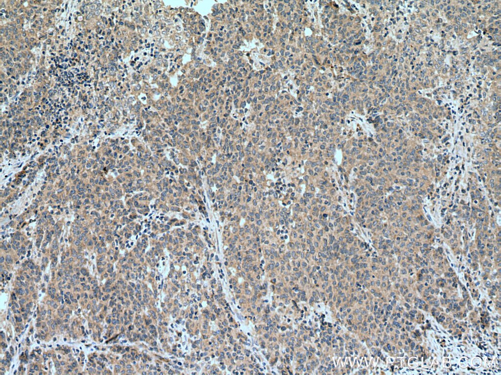 Immunohistochemistry (IHC) staining of human stomach cancer tissue using SEMA4C Polyclonal antibody (28402-1-AP)