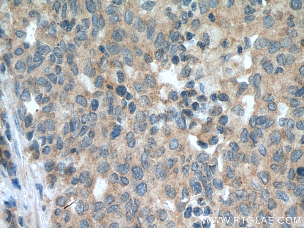 Immunohistochemistry (IHC) staining of human stomach cancer tissue using SEMA4C Polyclonal antibody (28402-1-AP)