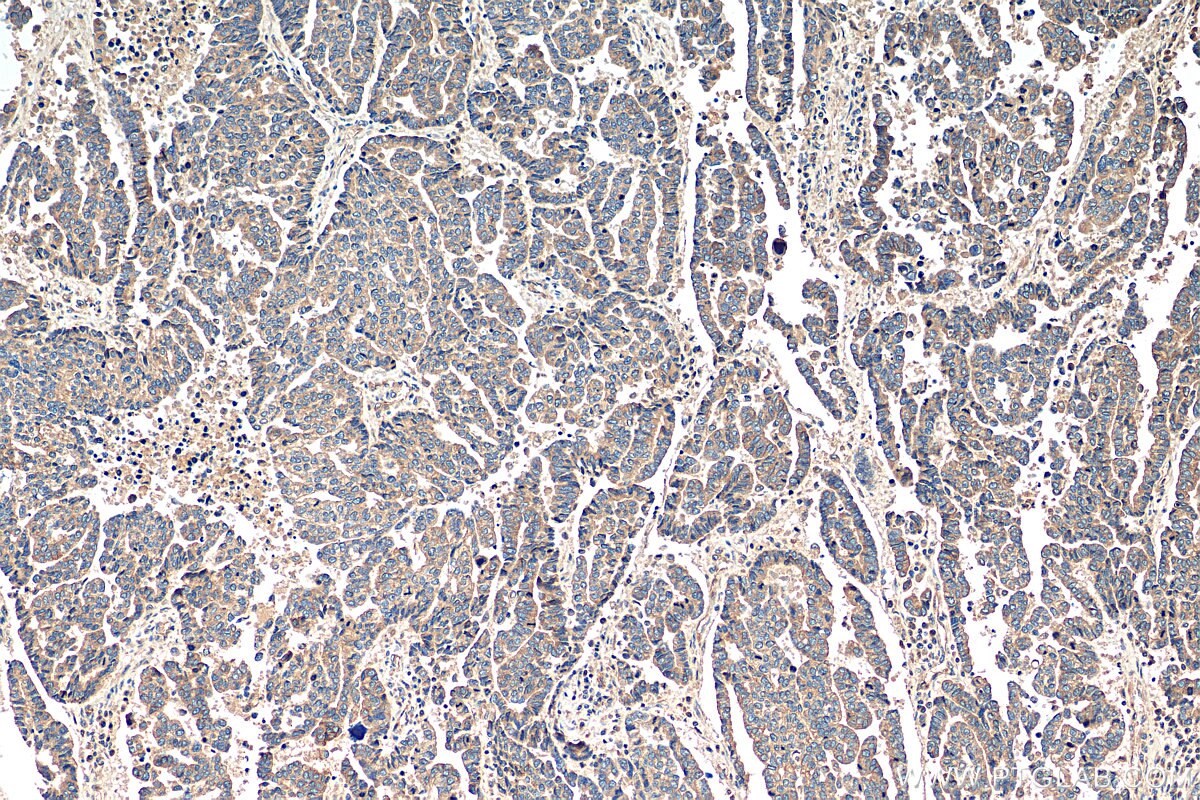 Immunohistochemistry (IHC) staining of human ovary tumor tissue using SEMA4C Polyclonal antibody (28402-1-AP)