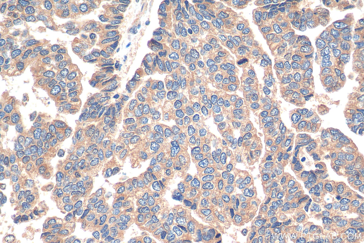 IHC staining of human ovary tumor using 28402-1-AP
