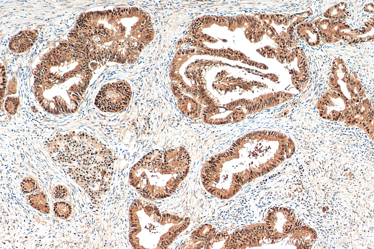 Immunohistochemistry (IHC) staining of human pancreas cancer tissue using SENP2 Polyclonal antibody (29772-1-AP)