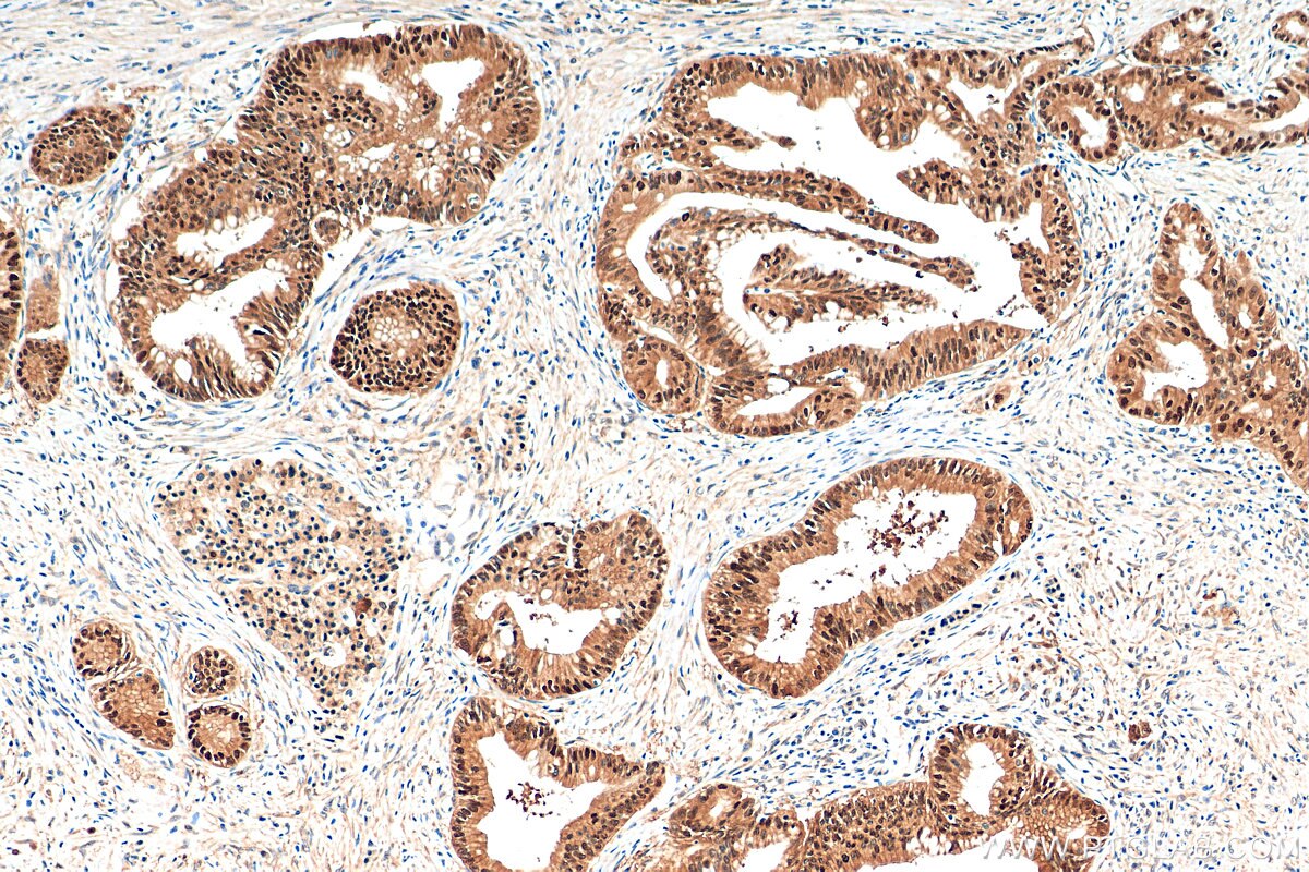 Immunohistochemistry (IHC) staining of human pancreas cancer tissue using SENP2 Polyclonal antibody (29772-1-AP)