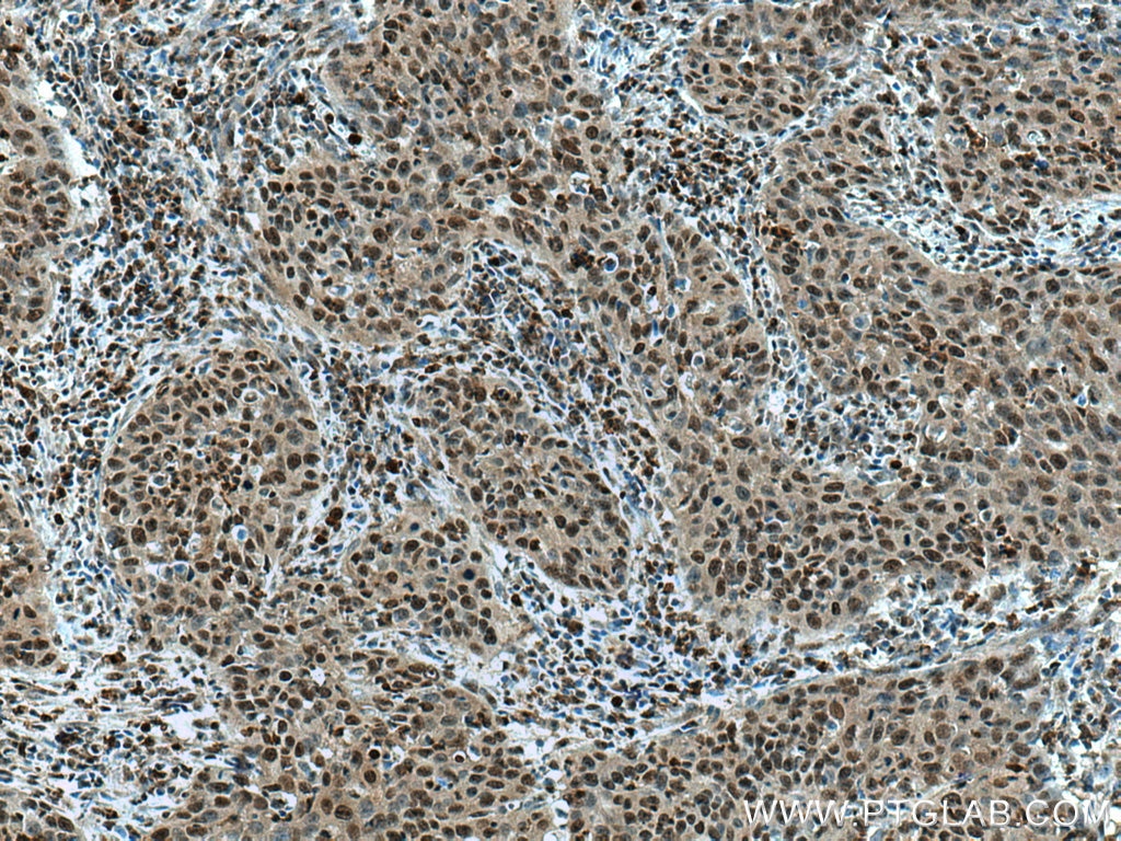 IHC staining of human cervical cancer using 19529-1-AP