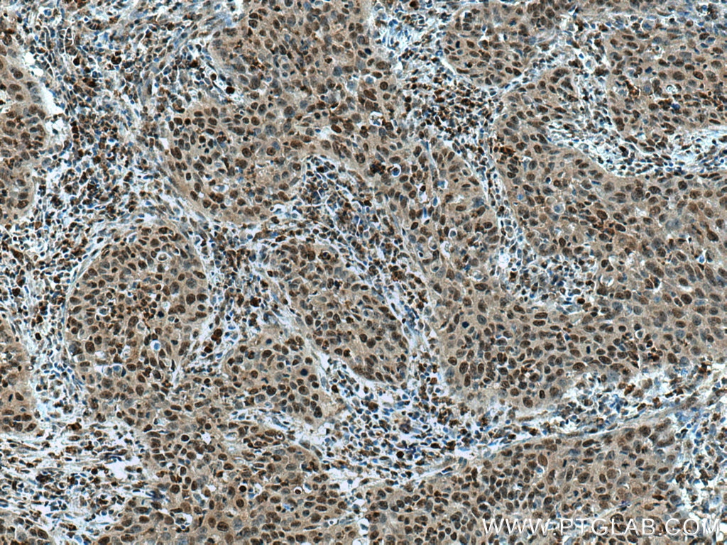 Immunohistochemistry (IHC) staining of human cervical cancer tissue using SENP5-Specific Polyclonal antibody (19529-1-AP)