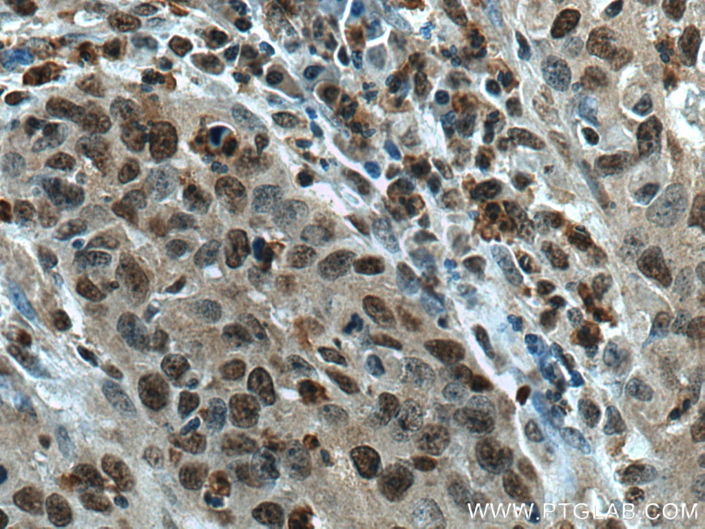 Immunohistochemistry (IHC) staining of human cervical cancer tissue using SENP5-Specific Polyclonal antibody (19529-1-AP)