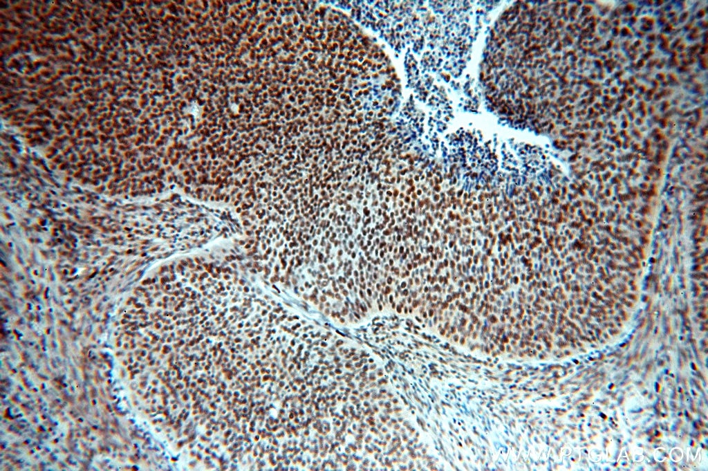 Immunohistochemistry (IHC) staining of human cervical cancer tissue using SENP5-Specific Polyclonal antibody (19529-1-AP)