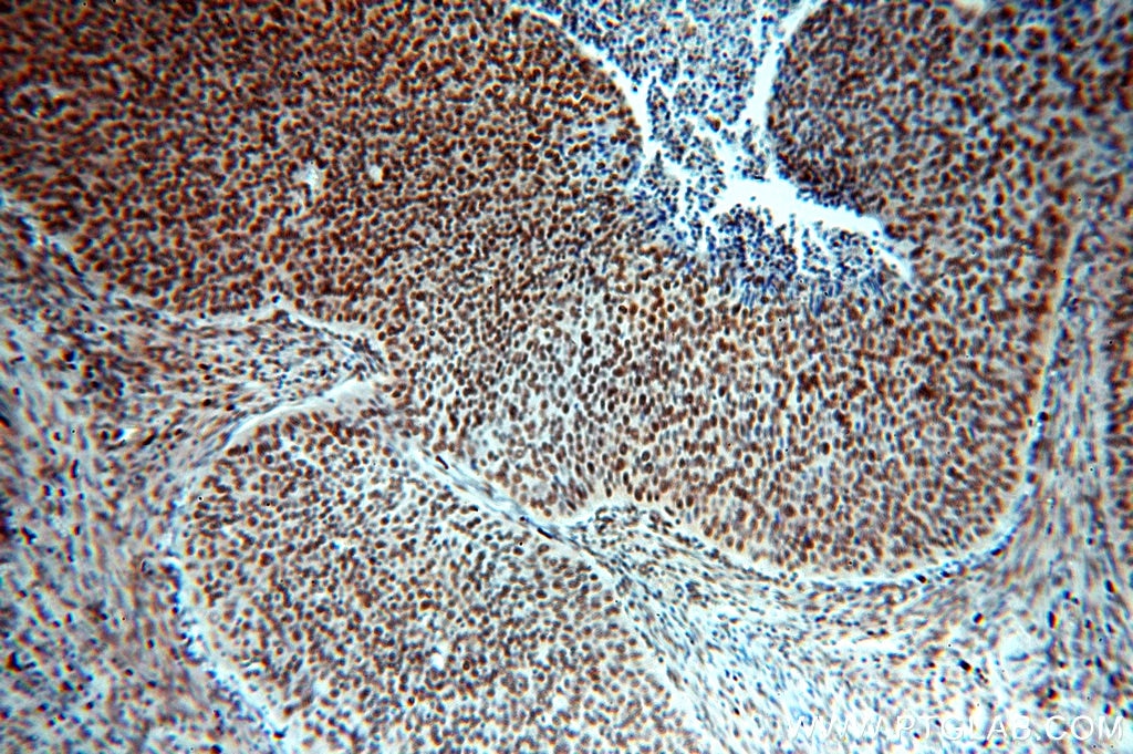 IHC staining of human cervical cancer using 19529-1-AP