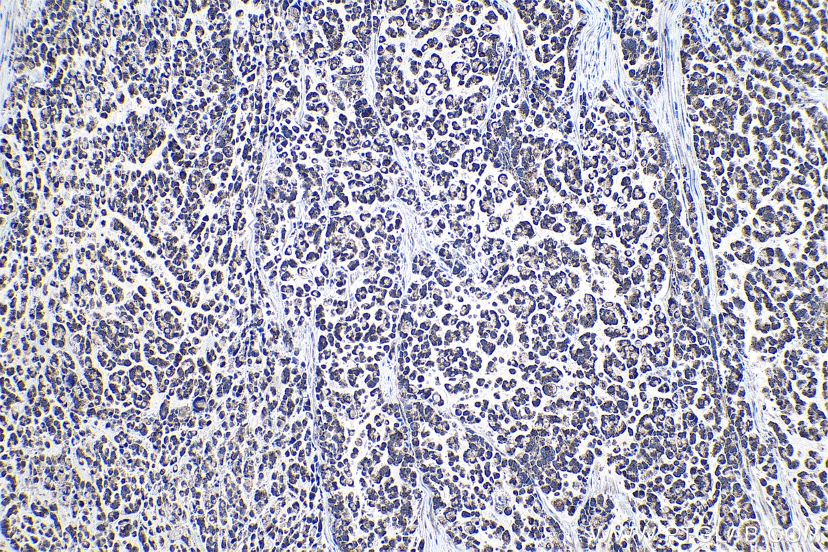 Immunohistochemistry (IHC) staining of human colon cancer tissue using SENP8 Polyclonal antibody (13479-1-AP)