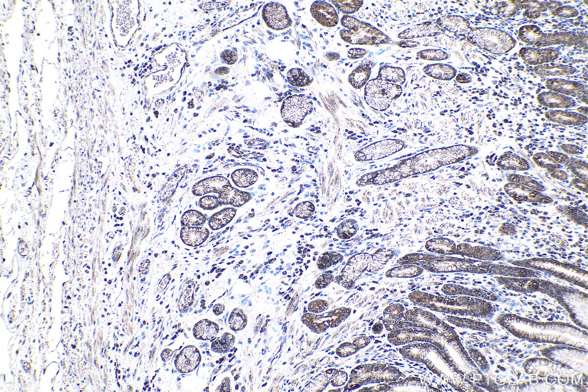 Immunohistochemistry (IHC) staining of human stomach cancer tissue using SENP8 Polyclonal antibody (13479-1-AP)