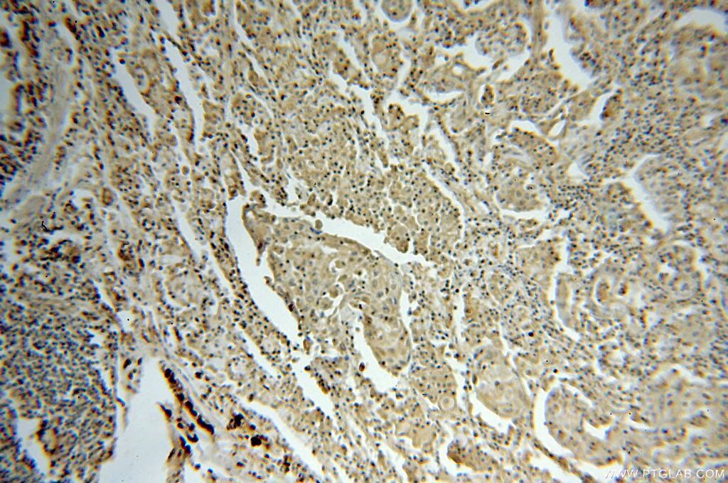 Immunohistochemistry (IHC) staining of human lung cancer tissue using SEPHS1 Polyclonal antibody (16635-1-AP)