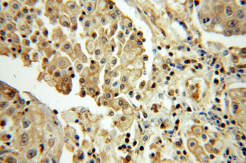 Immunohistochemistry (IHC) staining of human lung cancer tissue using SEPHS1 Polyclonal antibody (16635-1-AP)