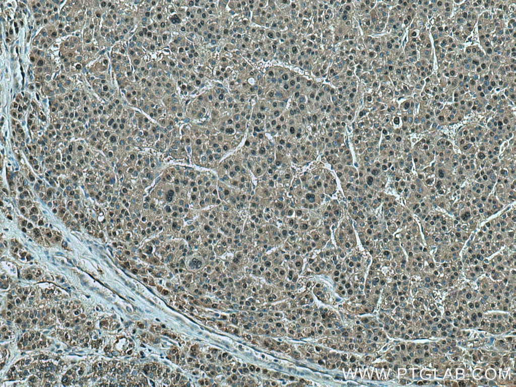 Immunohistochemistry (IHC) staining of human liver cancer tissue using SEPHS2 Polyclonal antibody (14109-1-AP)
