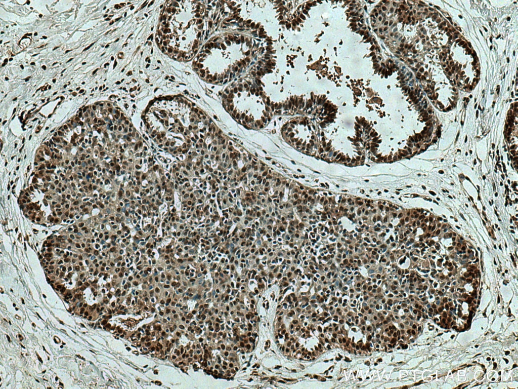 Immunohistochemistry (IHC) staining of human breast cancer tissue using SEPHS2 Polyclonal antibody (14109-1-AP)