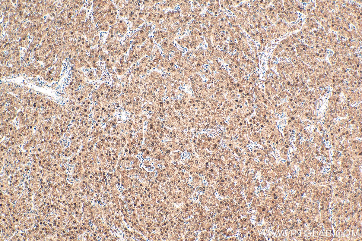 Immunohistochemistry (IHC) staining of human liver cancer tissue using SEPHS2 Polyclonal antibody (14109-1-AP)