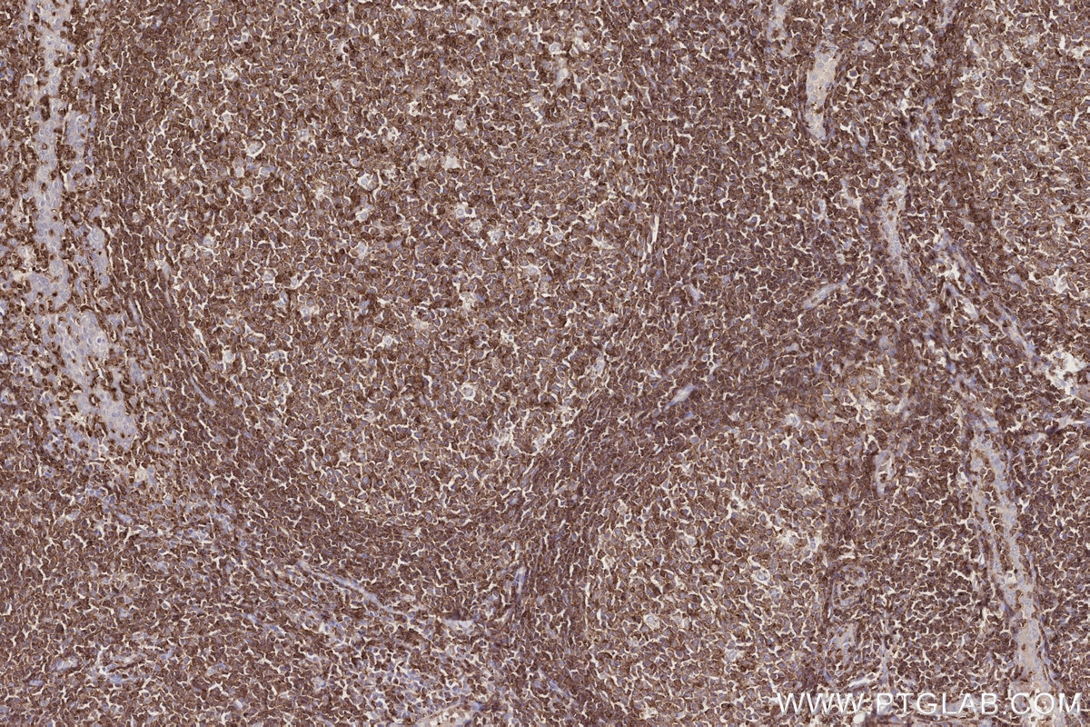 Immunohistochemistry (IHC) staining of human tonsillitis tissue using Septin 1 Polyclonal antibody (11370-1-AP)