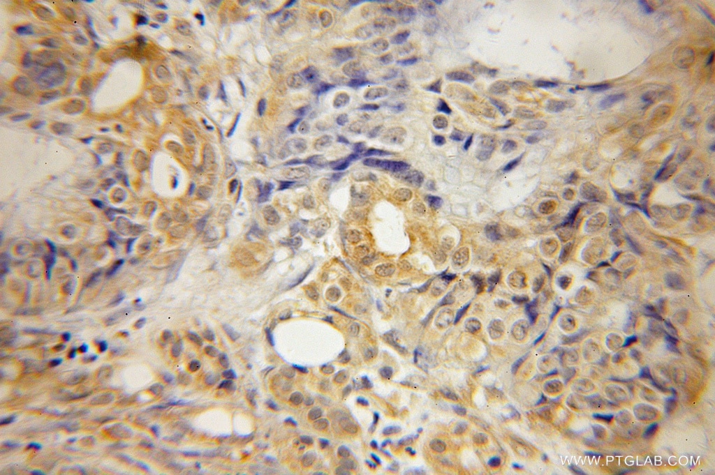 Immunohistochemistry (IHC) staining of human pancreas cancer tissue using Septin 10 Polyclonal antibody (12420-1-AP)