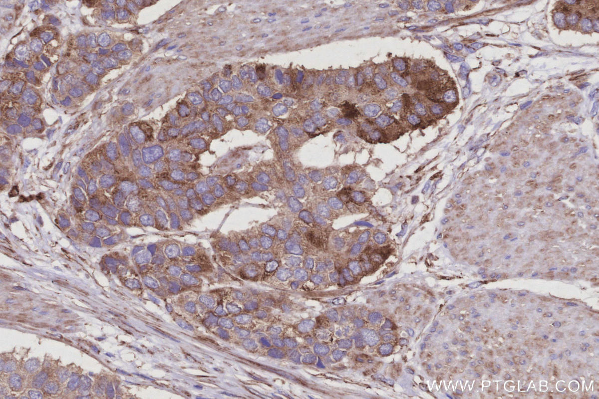 Immunohistochemistry (IHC) staining of human stomach cancer tissue using Septin 11 Polyclonal antibody (14672-1-AP)