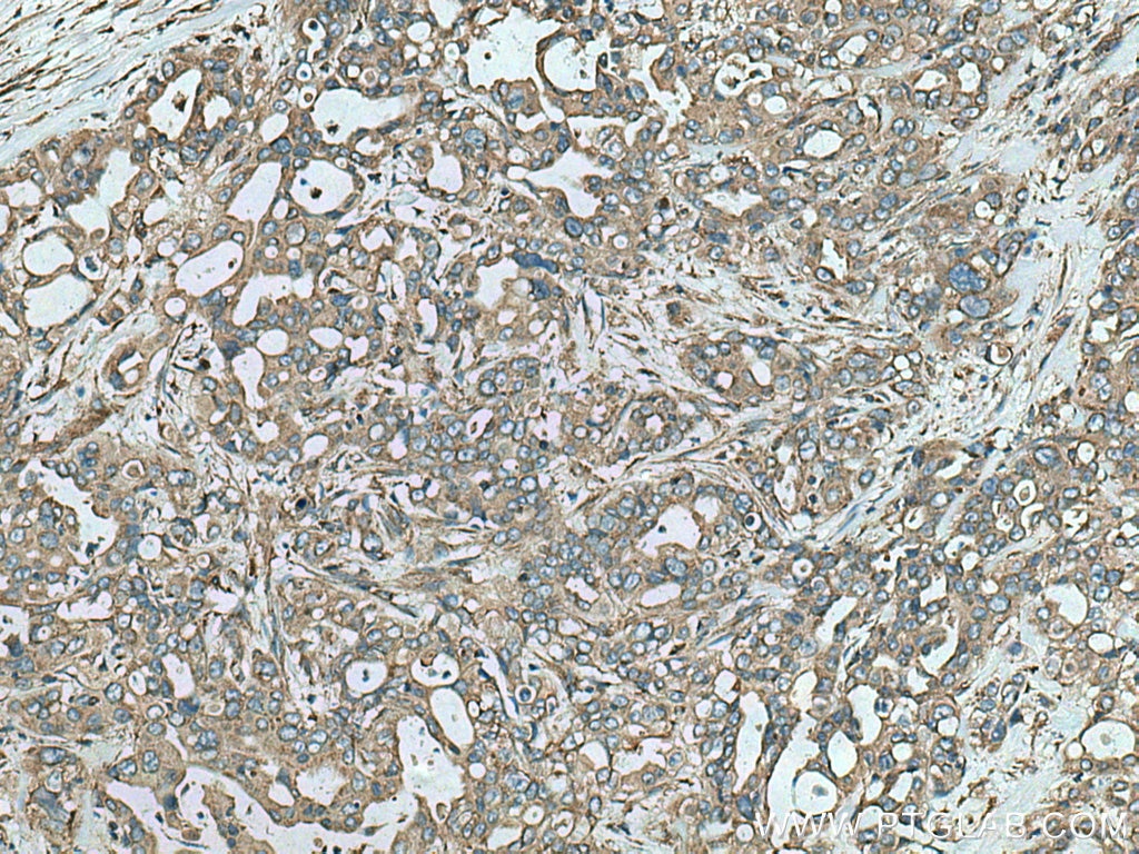 Immunohistochemistry (IHC) staining of human pancreas cancer tissue using Septin 2 Polyclonal antibody (11397-1-AP)