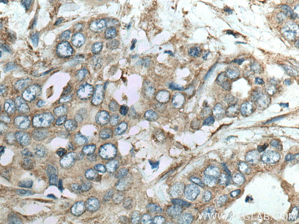 Immunohistochemistry (IHC) staining of human pancreas cancer tissue using Septin 2 Polyclonal antibody (11397-1-AP)