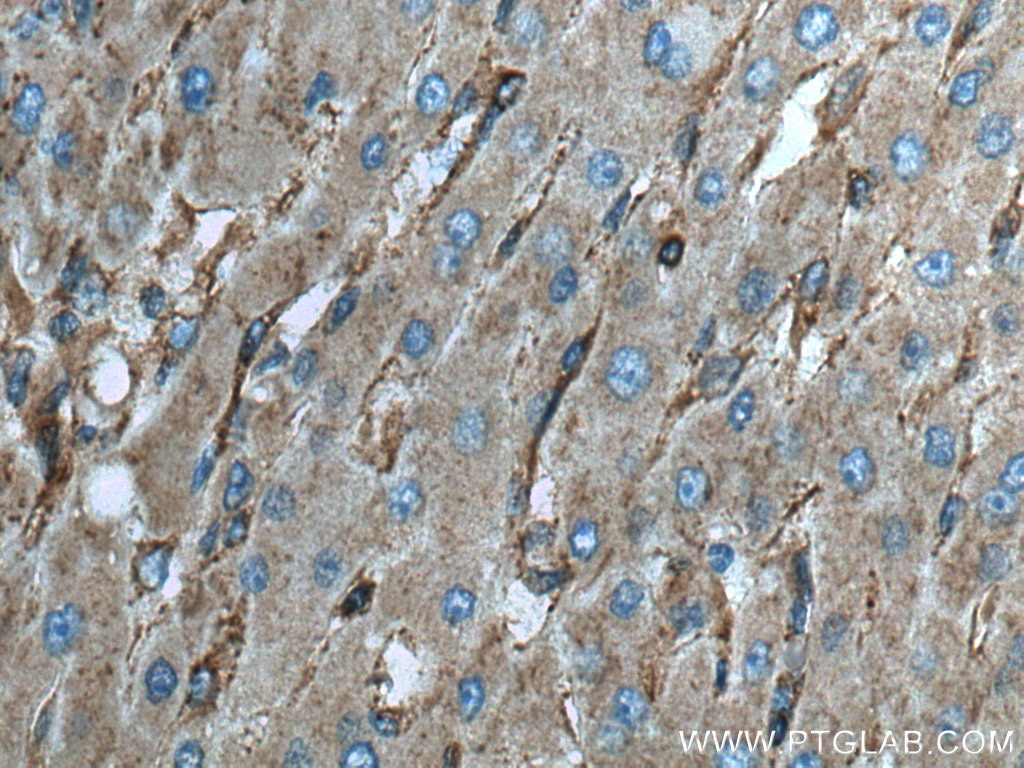 Immunohistochemistry (IHC) staining of human liver cancer tissue using Septin 2 Polyclonal antibody (11397-1-AP)