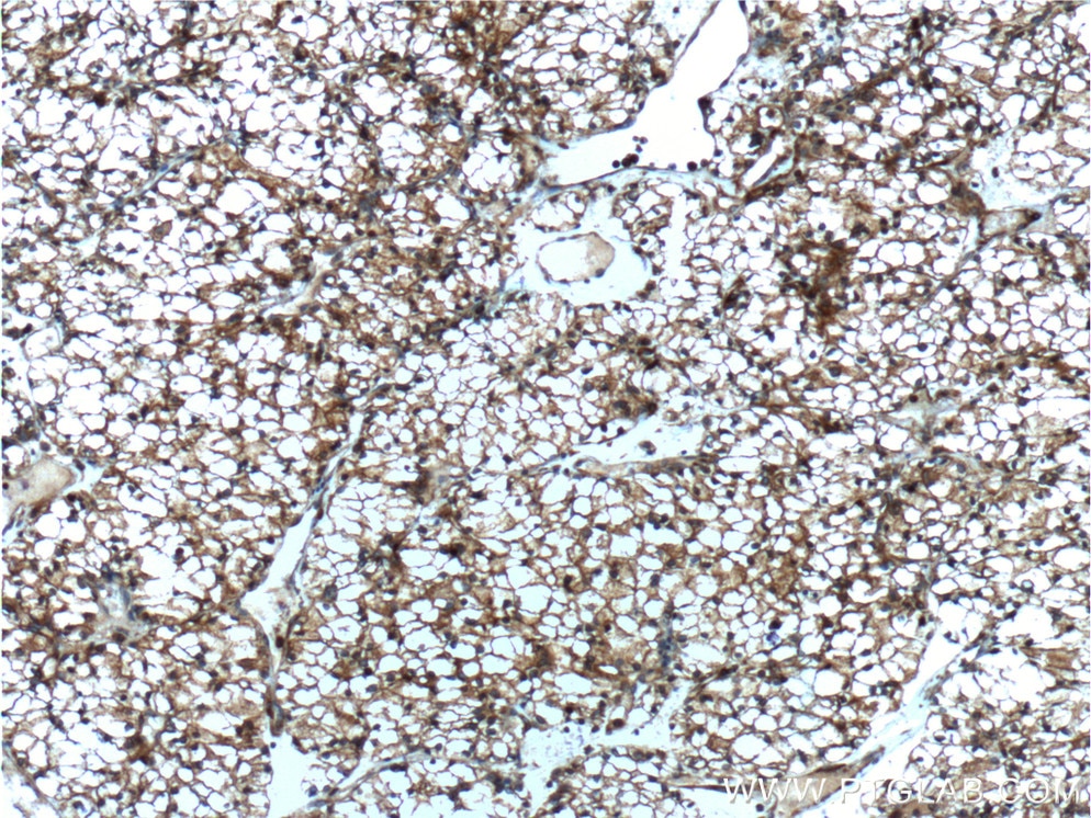 Immunohistochemistry (IHC) staining of human renal cell carcinoma tissue using Septin 2 Monoclonal antibody (60075-1-Ig)