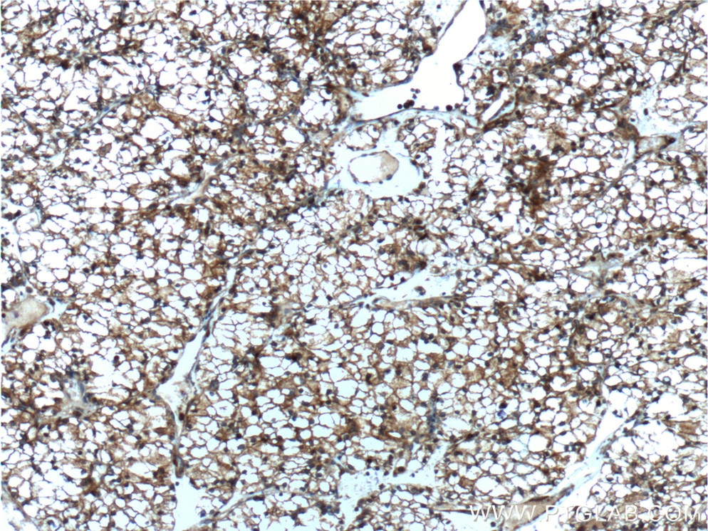 IHC staining of human renal cell carcinoma using 60075-1-Ig