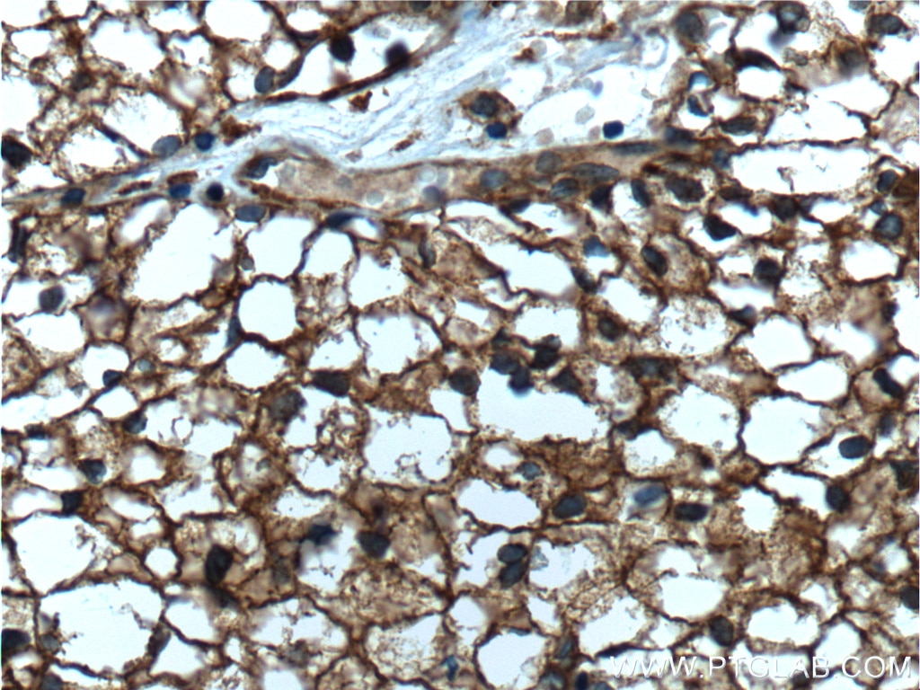 Immunohistochemistry (IHC) staining of human renal cell carcinoma tissue using Septin 2 Monoclonal antibody (60075-1-Ig)