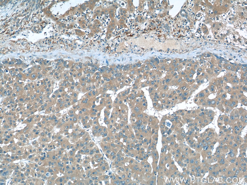 Immunohistochemistry (IHC) staining of human liver cancer tissue using Septin 2 Monoclonal antibody (60075-1-Ig)