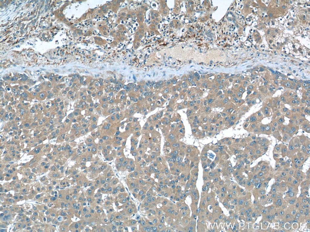 IHC staining of human liver cancer using 60075-1-Ig